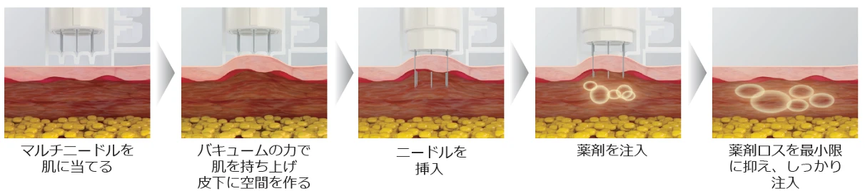 エクソヒーラーSBプラス(水光注射)