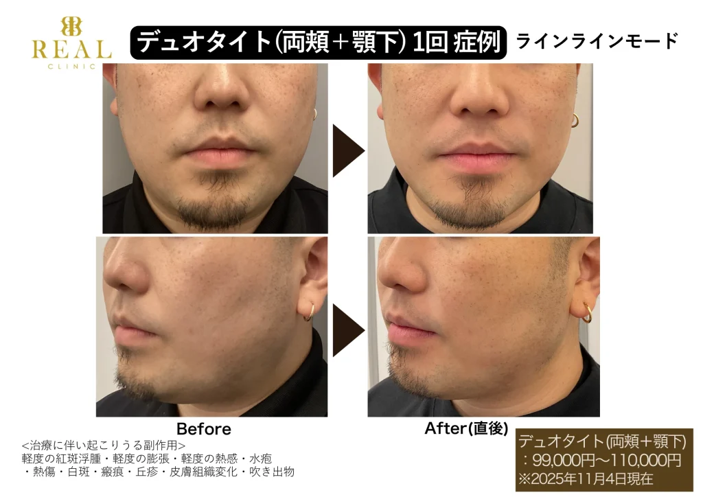 メンズ美容ビフォーアフター - デュオタイト（両頬＋顎下）1回症例