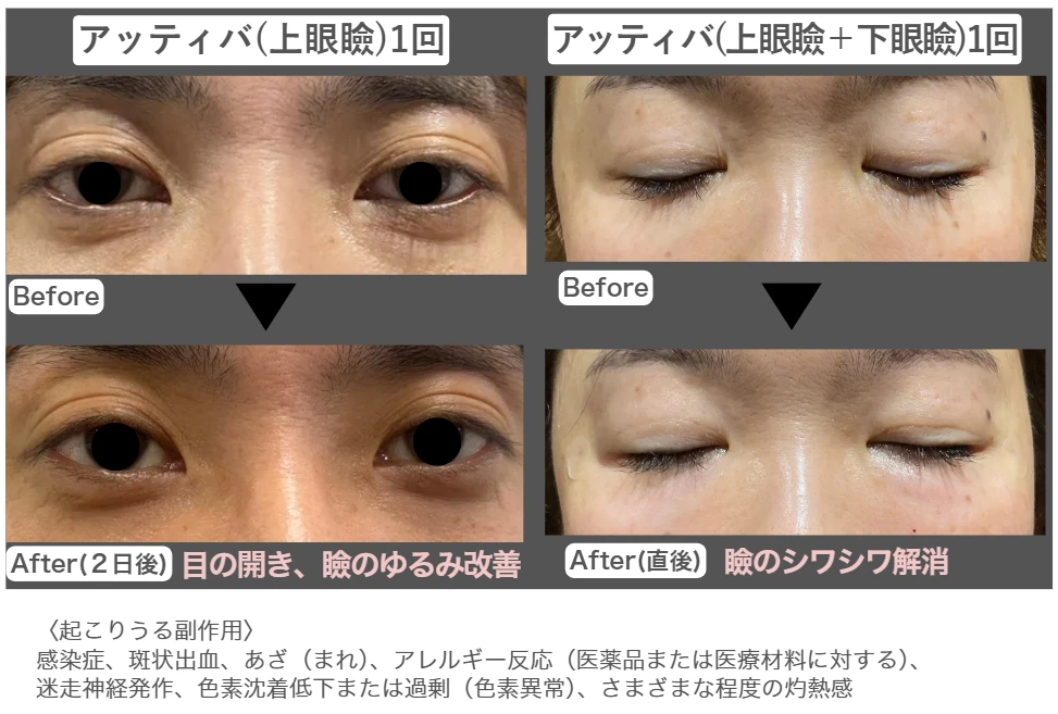 アッティバのビフォーアフター写真