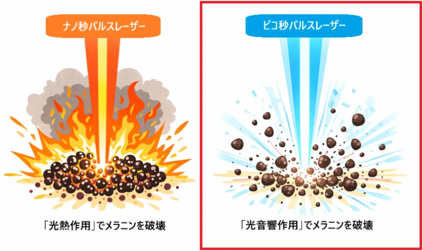 ヘリオス785。左側:ナノ秒パルスレーザーは光熱作用でメラニンを破壊。右側:ピコ秒パルスレーザーは光音響作用でメラニンを破壊