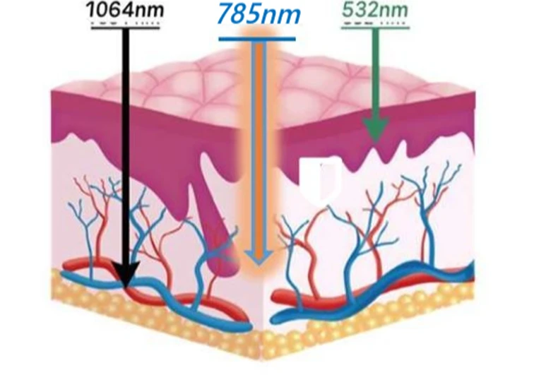 ヘリオス785 - 785nmは、血管を傷つけずに「ターゲットだけ」を射抜く