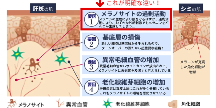 肝斑とシミの違い。肝斑はメラノサイトの過剰活動が要因。