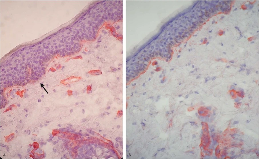 肝斑での基底膜の損傷状態