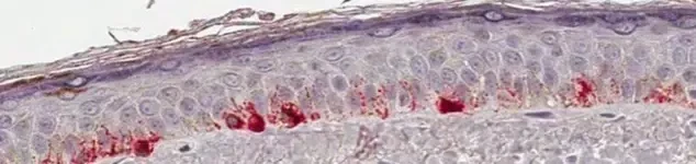 活性化メラノサイト