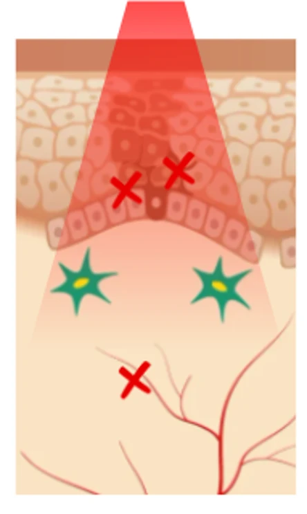 肝斑での低出力レーザー治療（レーザートーニング）による表皮付近のイラスト