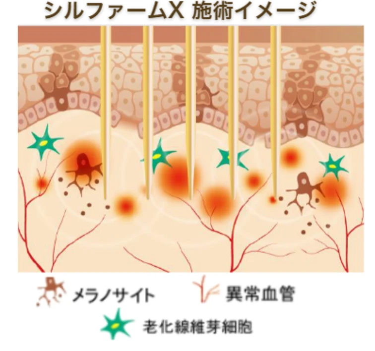 肝斑へのシルファーム X 施術イメージ