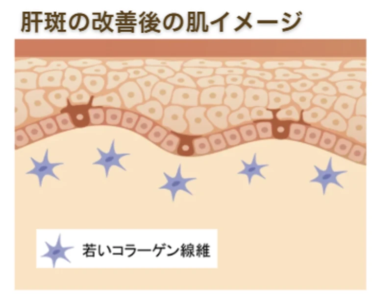 肝斑の改善後の肌イメージ
