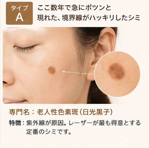 シミタイプの分類：タイプA