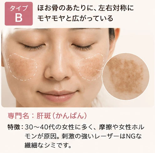 シミタイプの分類：タイプB
