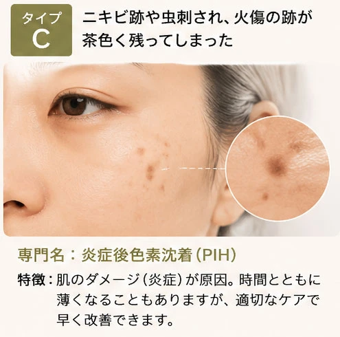 シミタイプの分類：タイプC
