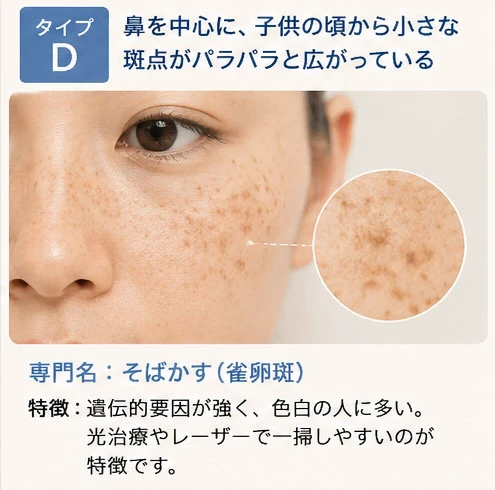 シミタイプの分類：タイプD