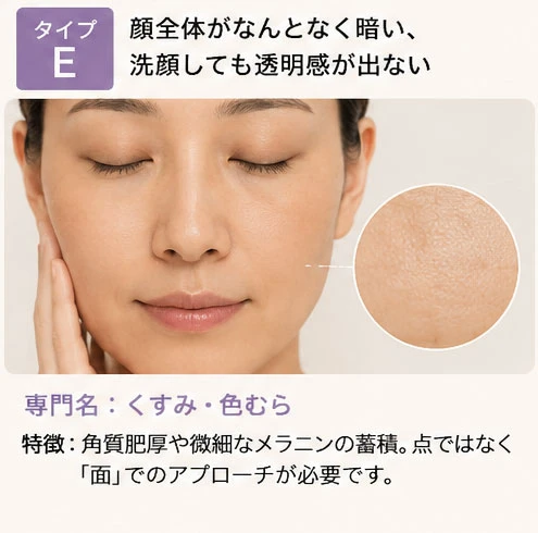 シミタイプの分類：タイプE