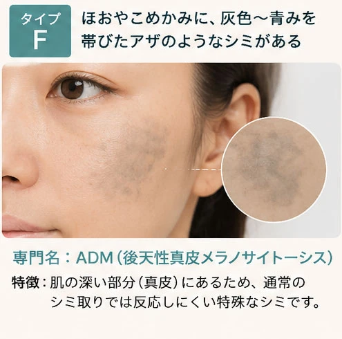 シミタイプの分類：タイプF