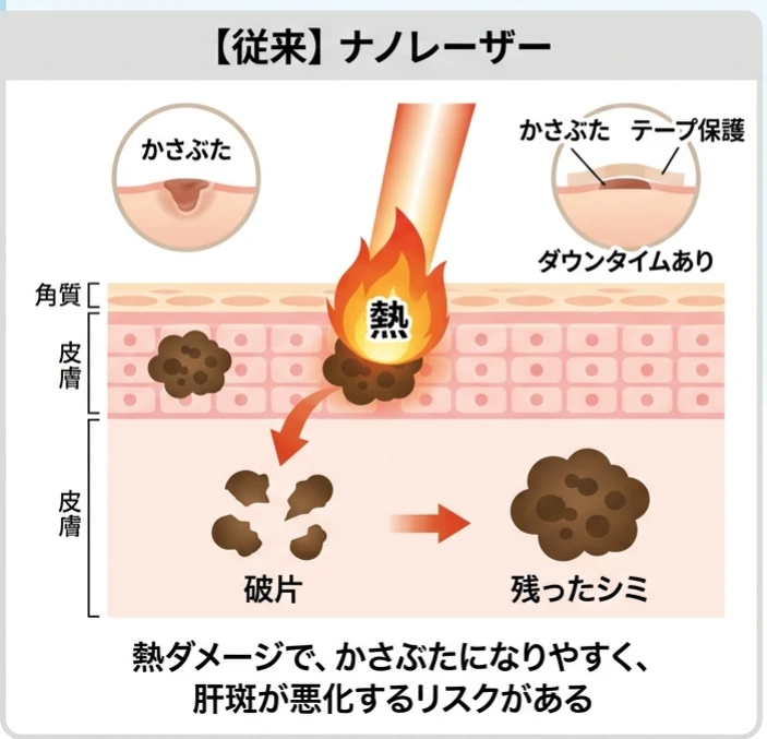 従来のナノレーザー：熱ダメージで、かさぶたになりやすく、肝斑が悪化するリスクがある。