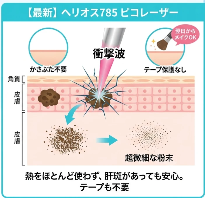 最新のヘリオス785ピコレーザー：熱をほとんど使わず、肝斑があっても安心。テープも不要。