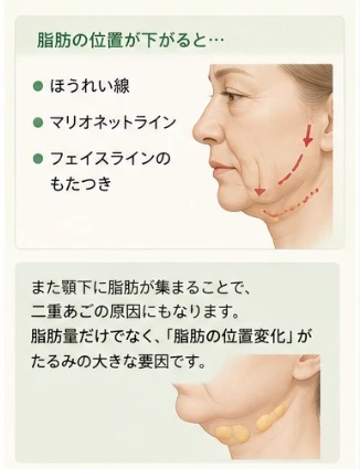 ほうれい線、マリオネットライン、フェイスラインのもたつき