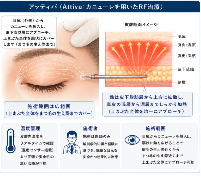 アッティバ（Attiva: カニューレを用いたRF治療）