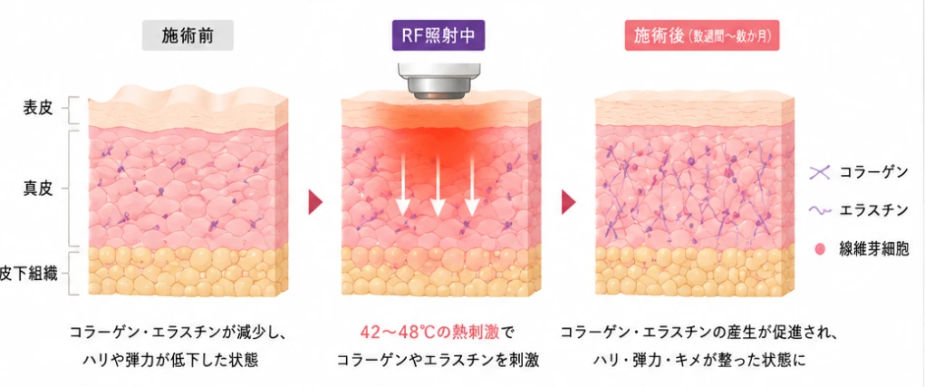施術前、RF照射中、施術後の皮膚の状態