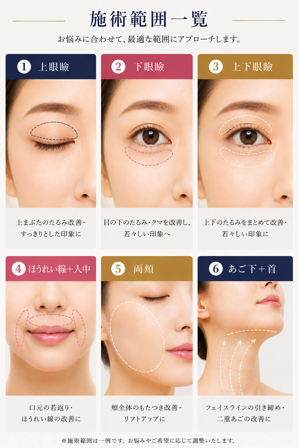 施術範囲一覧：上眼瞼、下眼瞼、上下眼瞼、ほうれい線＋人中、両頬、あご下＋首
