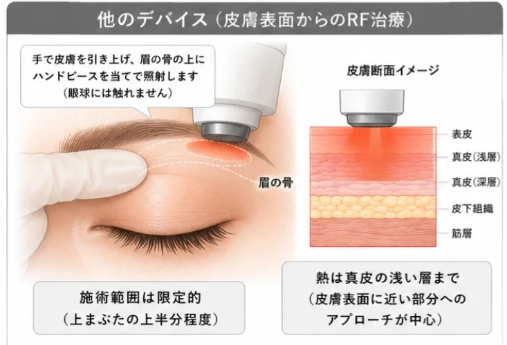 他のデバイス（皮膚表面からのRF治療）