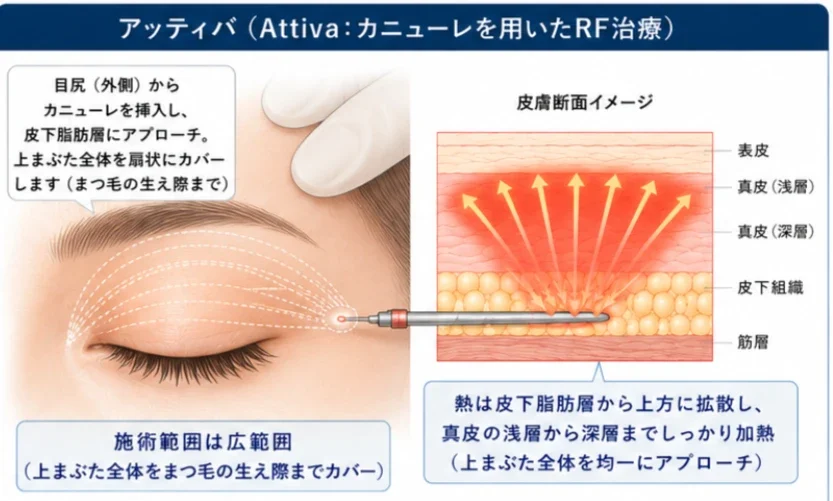 アッティバ（Attiva: カニューレを用いたRF治療）
